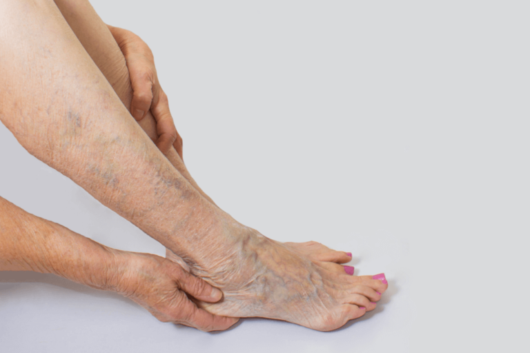 várices, enfermedades varicosas, arañitas